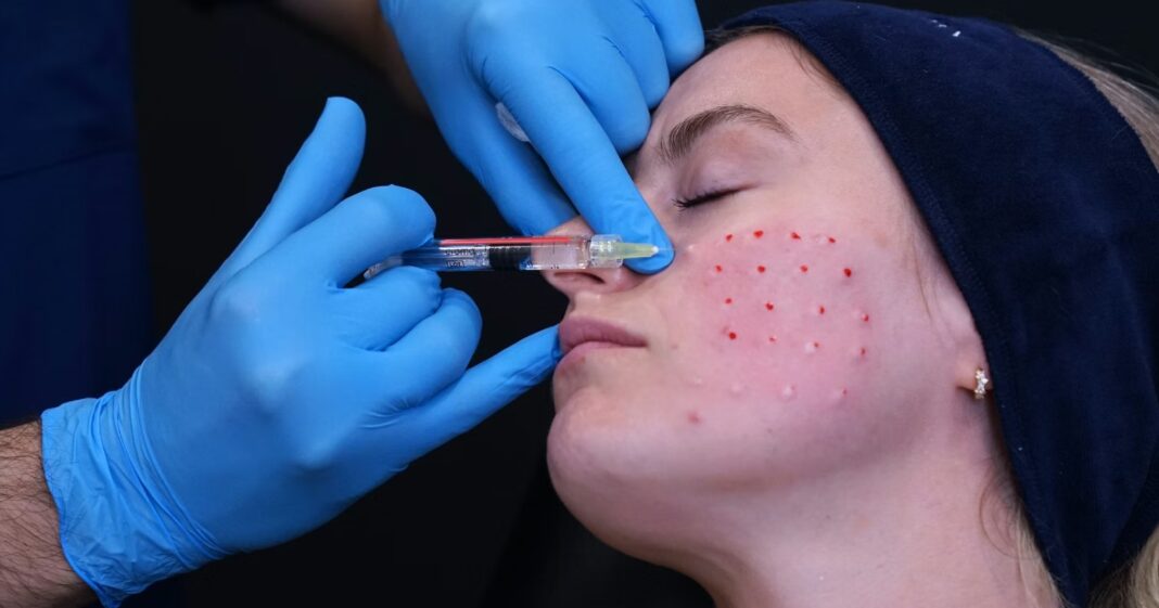 Injections de Polynucléotides : L’Anti-Âge Révolutionnaire