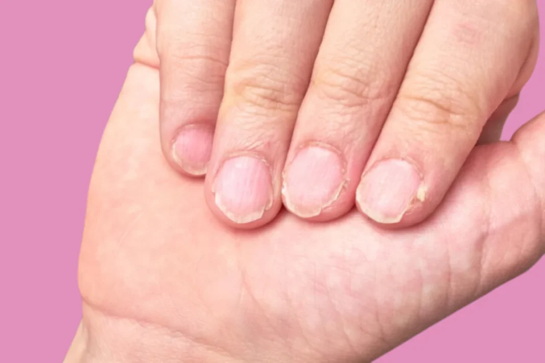 Ongles mal coupés : signes alarmants à ne pas ignorer